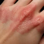 sarampion-mexico-acumula-5-mil-860-casos-confirmados-y-24-defunciones-michoacan-en-el-top-5-1024x573