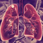 pulmones-tuberculosis